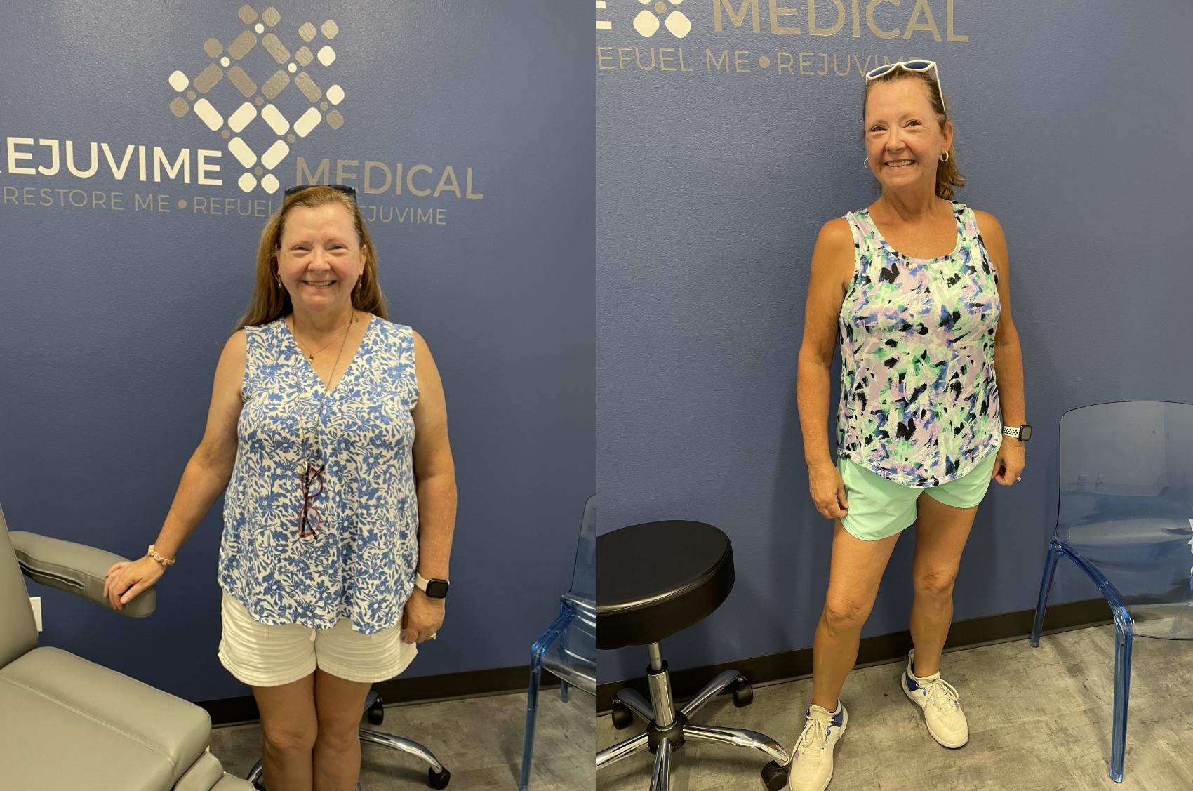 Before & After Semaglutide Case 15 Front View in Baton Rouge, Metairie, Slidell, Shreveport, Houma, Monroe, Prairieville, and D'lberville, Louisiana and Mississippi